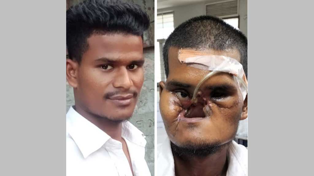 আন্দোলনে আহত খোকনকে পাঠানো হচ্ছে রাশিয়ায়