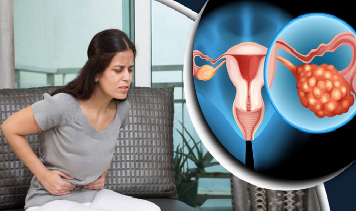 নীরব ঘাতক ওভারিয়ান ক্যানসার