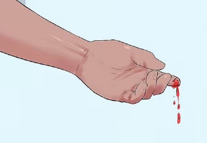 চিকিৎসার বাইরে ৯০ ভাগ হিমোফিলিয়া রোগী